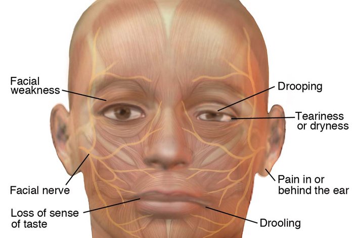 BellsPalsy LG