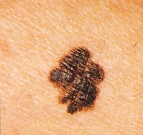 mole showing border irregularity